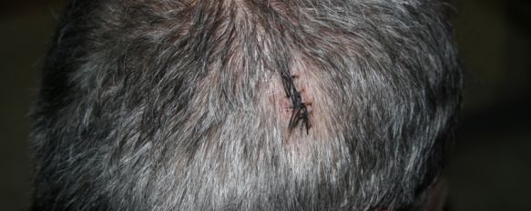 Ingresa en un centro psiquiátrico tras propinar un martillazo en la cabeza a un hombre , R.C.C., un rondeño de 54 años, se dirigía a su garaje cuando fue atacado por la espalda con un martillo, 10 May 2012 - 17:28