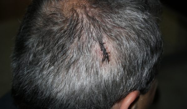 El agredido sufre mareos y dolores de espalda desde el ataque.