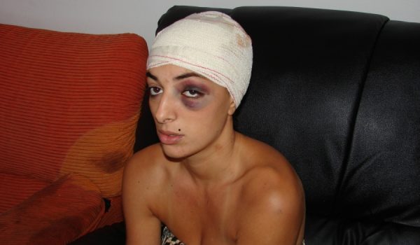 La joven rondeña sufrió una fractura craneal incisa.